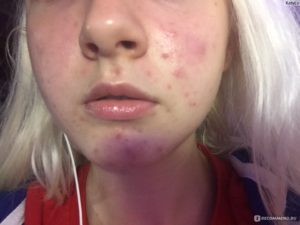 Ожог лица салициловой кислотой