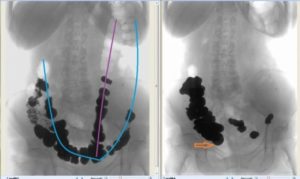 После клизмы нет стула 5 дней