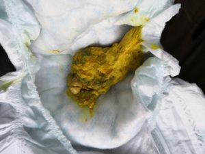 У ребенка кал как пластилин