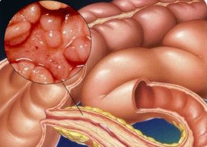 Проктосигмоидит