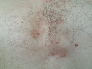 Красные пятна на лобковой части, чешутся и шелушатся