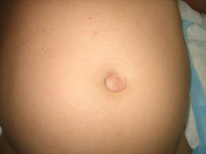 Боль в пупке после родов