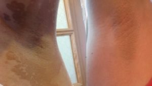 Белые пятна на подмышках