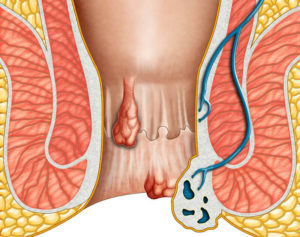 Болит задний проход, не могу больше
