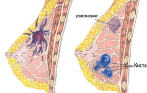 Комки в груди при грудном вскармливании