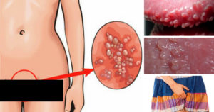 Зуд во влагалище и области ануса