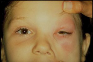 Отек левый глаз