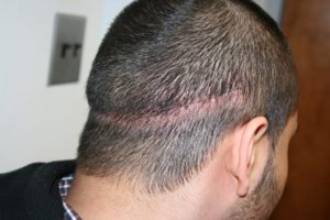 Волосы на шраме