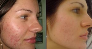 Ожог лица салициловой кислотой