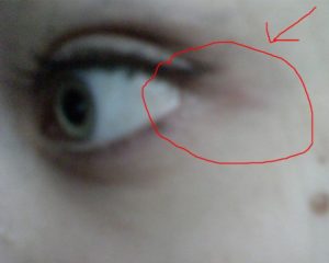 Синяк на внешнем уголке глаза