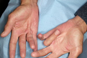 Аксонопатия в запущенной стадии. Можно ли ее вылечить?