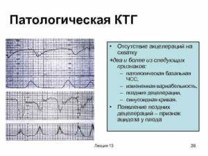 Расшифровка КТГ 8 баллов, много акцелираций и присутствуют децелерации