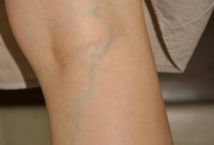 Просвечивают вены на ногах