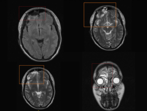Арахноидальные изменения ликворокистозного характера