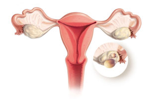 Лопнула киста