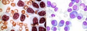 Атипичные лимфоциты и плазматические клетки