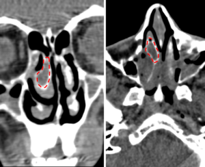 Конхобуллез