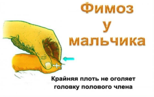 Красная крайняя плоть у ребенка