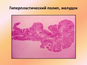 Полип в кишечнике, гиперплазия