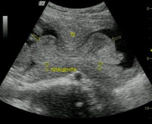 Плацента на передней стенке. Расширение МВП. Анэхогенная структура