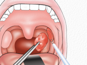 Могут ли вырасти новые миндалины