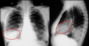 Скрытая пневмония или туберкулез