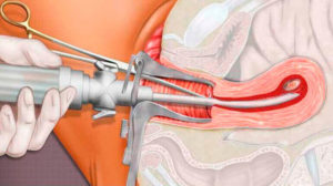 Кровотечение после вакуумной аспирации