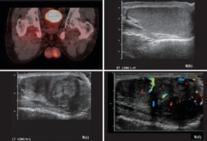 Подозрение на рак яичка