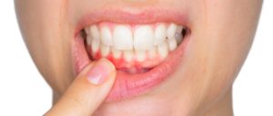 Температура, воспаление дёсен, слабость