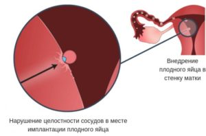 Задержка при эндометриозе