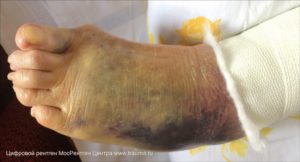 Волдыри, пузыри под гипсом, отек, синюшность