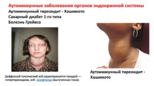 Анти-ТПО. Узловой зоб с признаками АИТ, гипотериоз