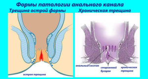 Сторожевой бугорок