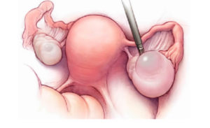 Лопнула киста