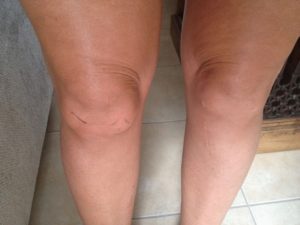 Отек внутренней стороны бедра и варикоз