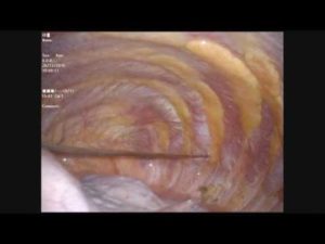 Плеврэктомия при буллезной эмфиземе