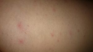 Мелкие красные прыщи на теле и чешутся
