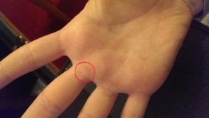 Образование на сгибе пальца под кожей, болит при нажатии