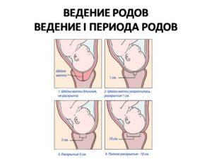 Роды 41-42 недели, шейка матки не готова