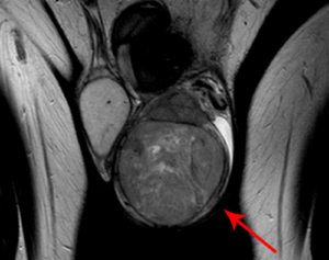 Подозрение на рак яичка