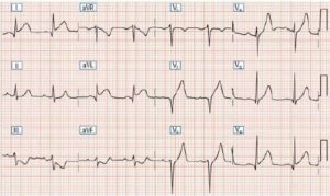 Смещение ST вниз (V5) / Отклонение параметров qrs (avr)