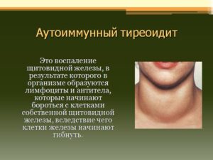Анти-ТПО. Узловой зоб с признаками АИТ, гипотериоз