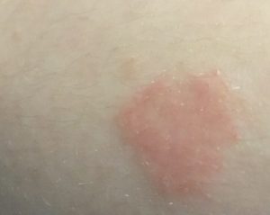 Красные пятна на лобковой части, чешутся и шелушатся