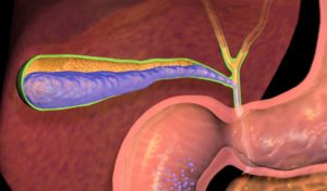 Холецистит, застой желчи, сладж в пузыре