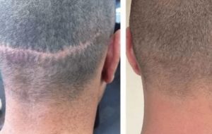 Волосы на шраме