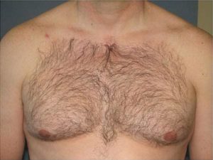 Плохо растут волосы на теле