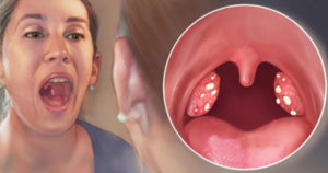 На миндалине появилось белое пятно