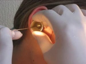 Прокол барабанной перепонки-правильно назначено лечение, чтобы избежать дальнейших последствий?