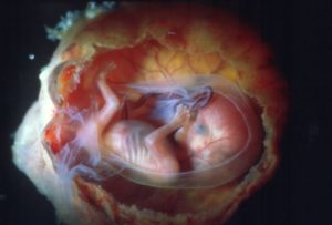 Замершая беременность 15-16 недель