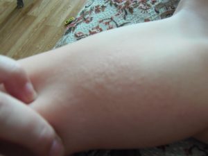 Сыпь на бедре у ребёнка